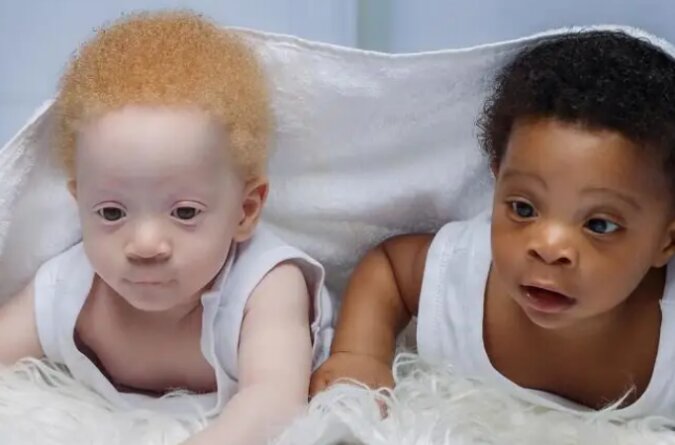 Zwillingsbrüder wurden im Abstand von einer Minute geboren, aber mit der differenten Hautfarbe