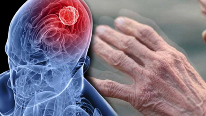 Parkinson-Symptome. Quelle: facenews.com