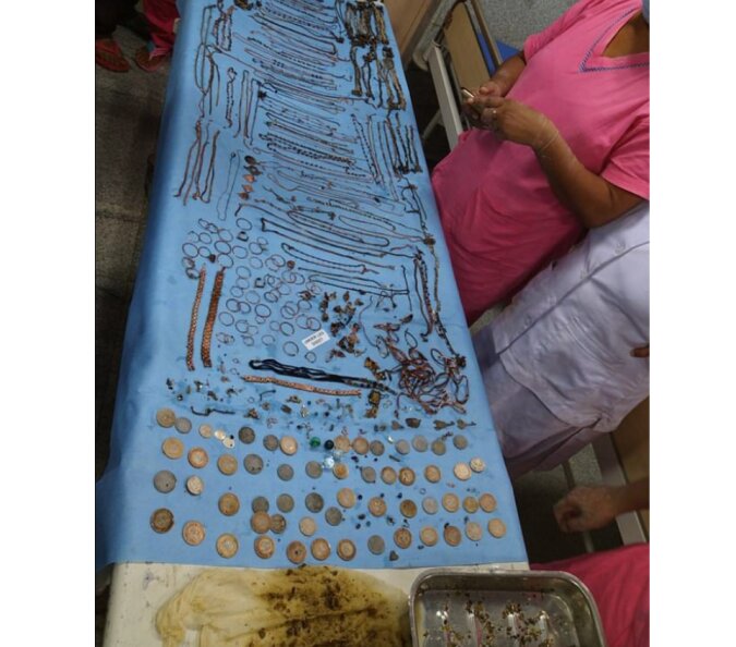 Chirurgen entfernten 1,5 kg Schmuck und Münzen aus dem Bauch einer Frau
