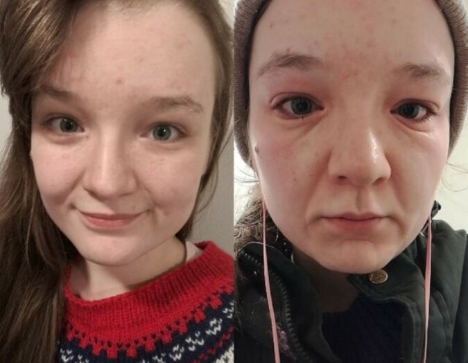 Aufgrund einer Allergie gegen Kälte wird eine junge Frau in wenigen Minuten mehrere Jahre älter